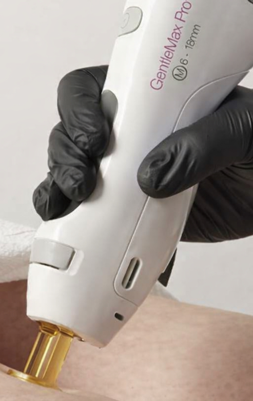 Laser Hair Removal